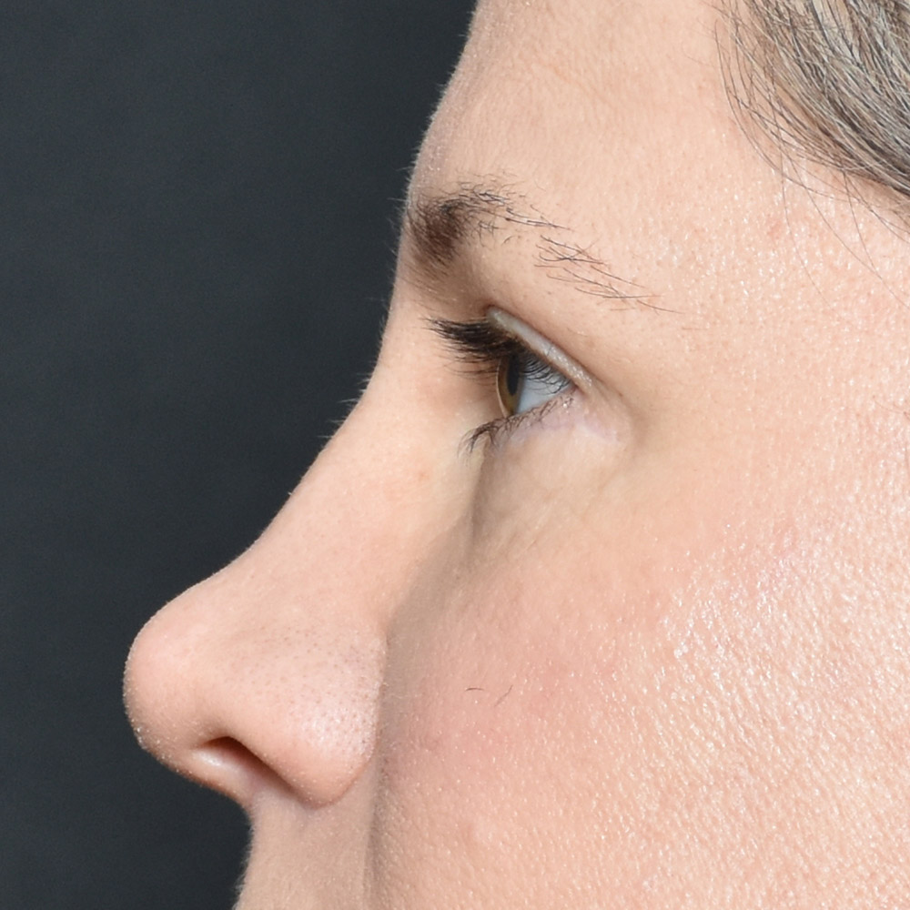 11060 After Blepharoplasty - Lake Oswego and Portland, Oregon