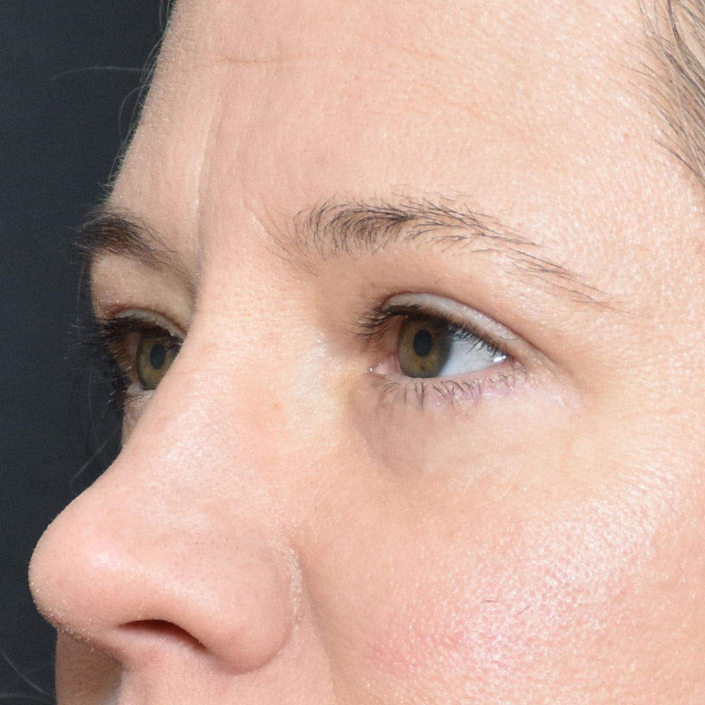 11060 After Blepharoplasty - Lake Oswego and Portland, Oregon