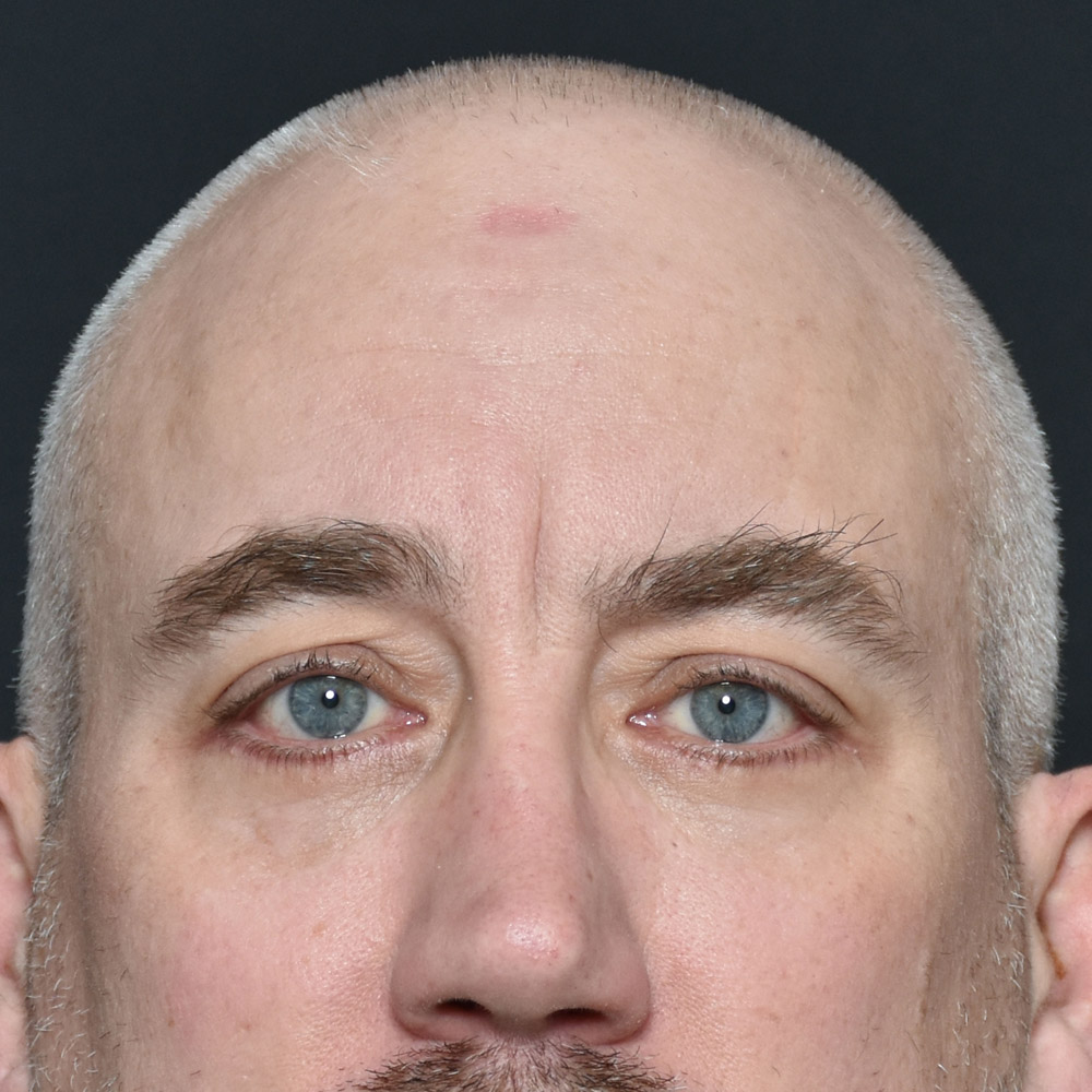 Case--11504 | After Lower Blepharoplasty