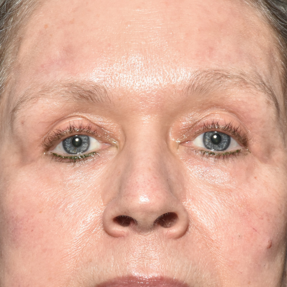 Case--7435 | After Brow Lift Surgery