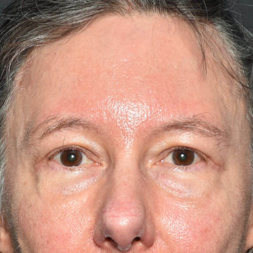 Case--9410 | After Brow Lift Surgery
