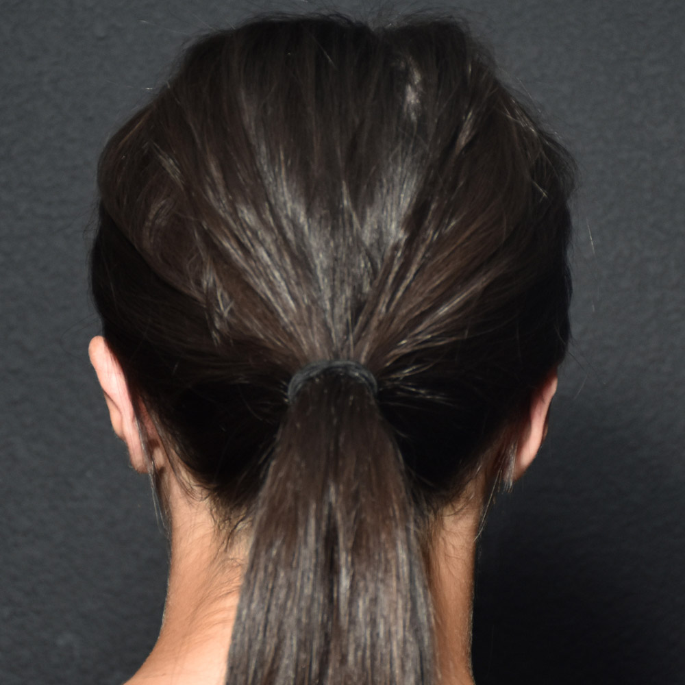 53532 Before Ear Pinning Surgery - Lake Oswego and Portland, Oregon