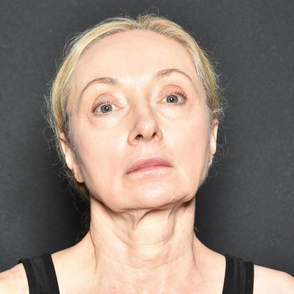 Case--3334 | Before Facelift and Neck Lift
