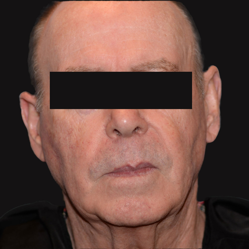 Case--2113 | Before Facelift and Neck Lift