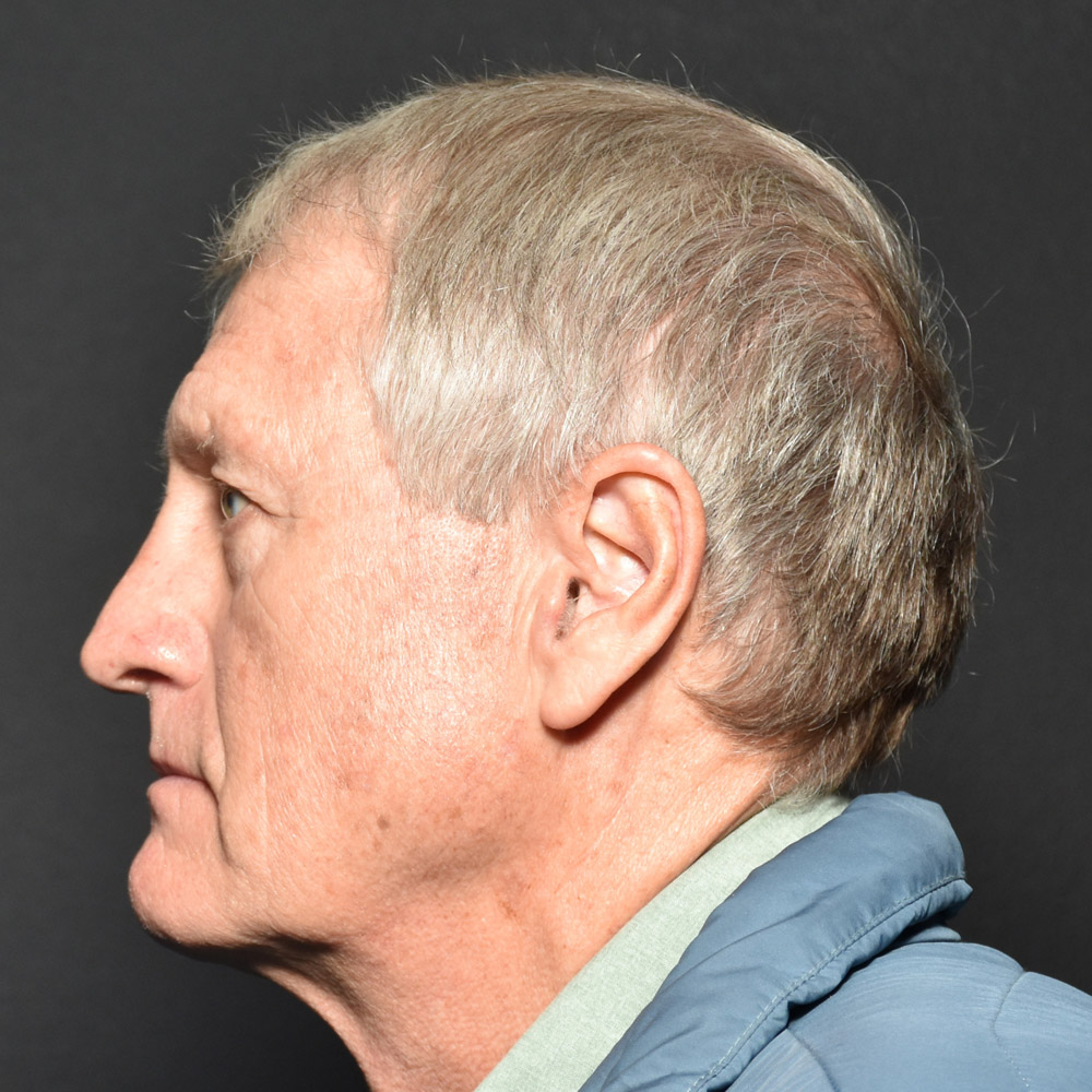Case--7230 | Before Male Facelift 2