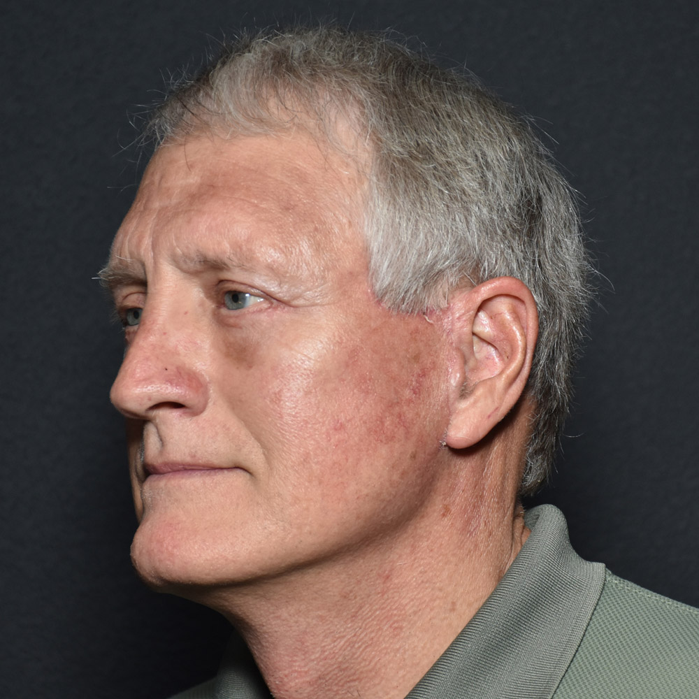 Case--7230 | After Male Facelift 3