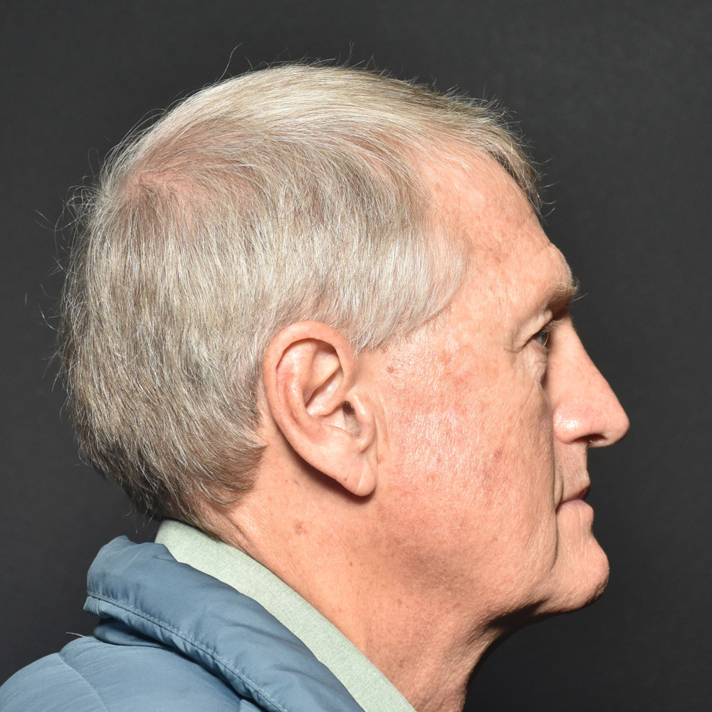 Case--7230 | Before Male Facelift 4