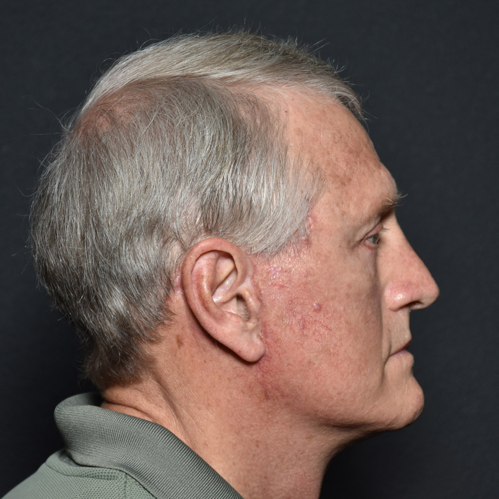 Case--7230 | After Male Facelift 4