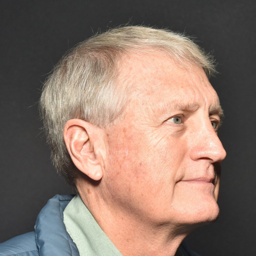 Case--7230 | Before Male Facelift 5