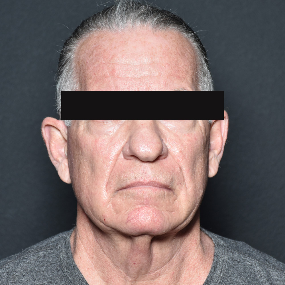 Case--8828 | Before Facelift and Neck Lift