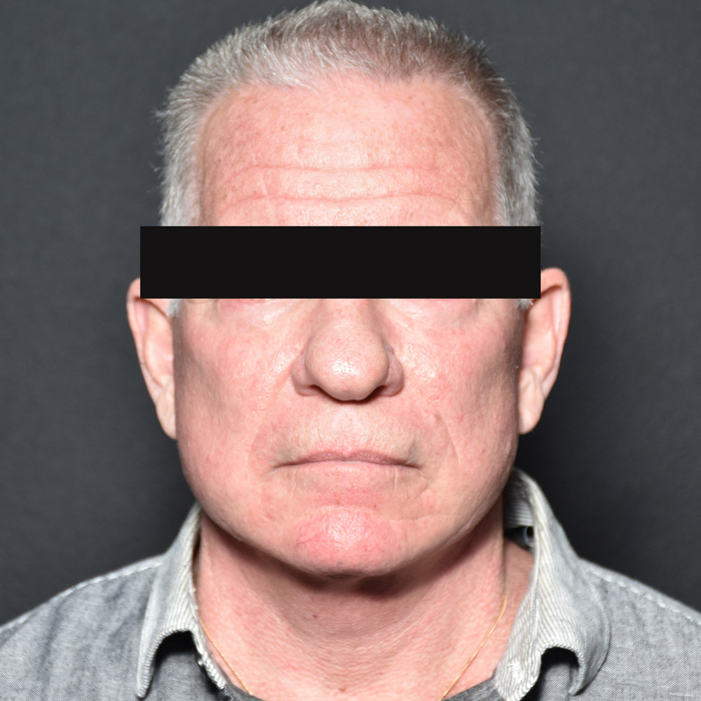 Case--8828 | After Facelift and Neck Lift