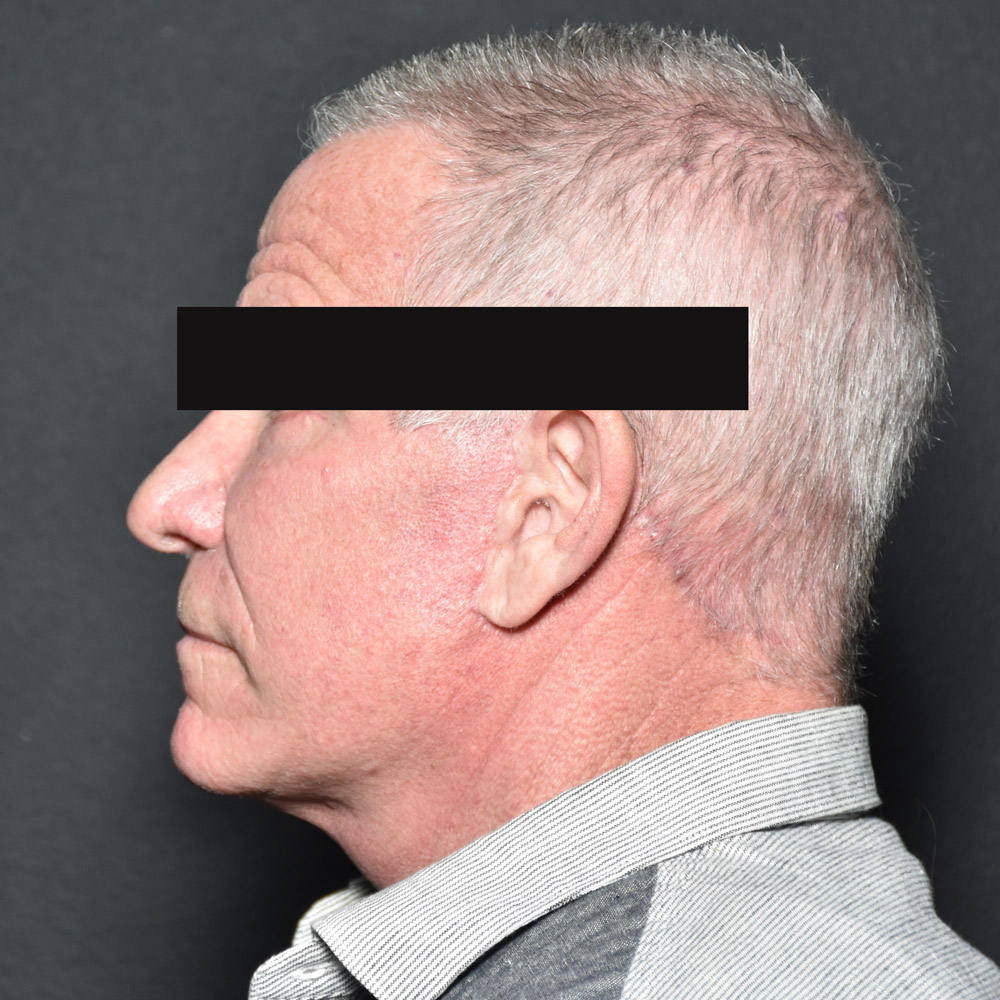 Case--8828 | After Facelift and Neck Lift 3