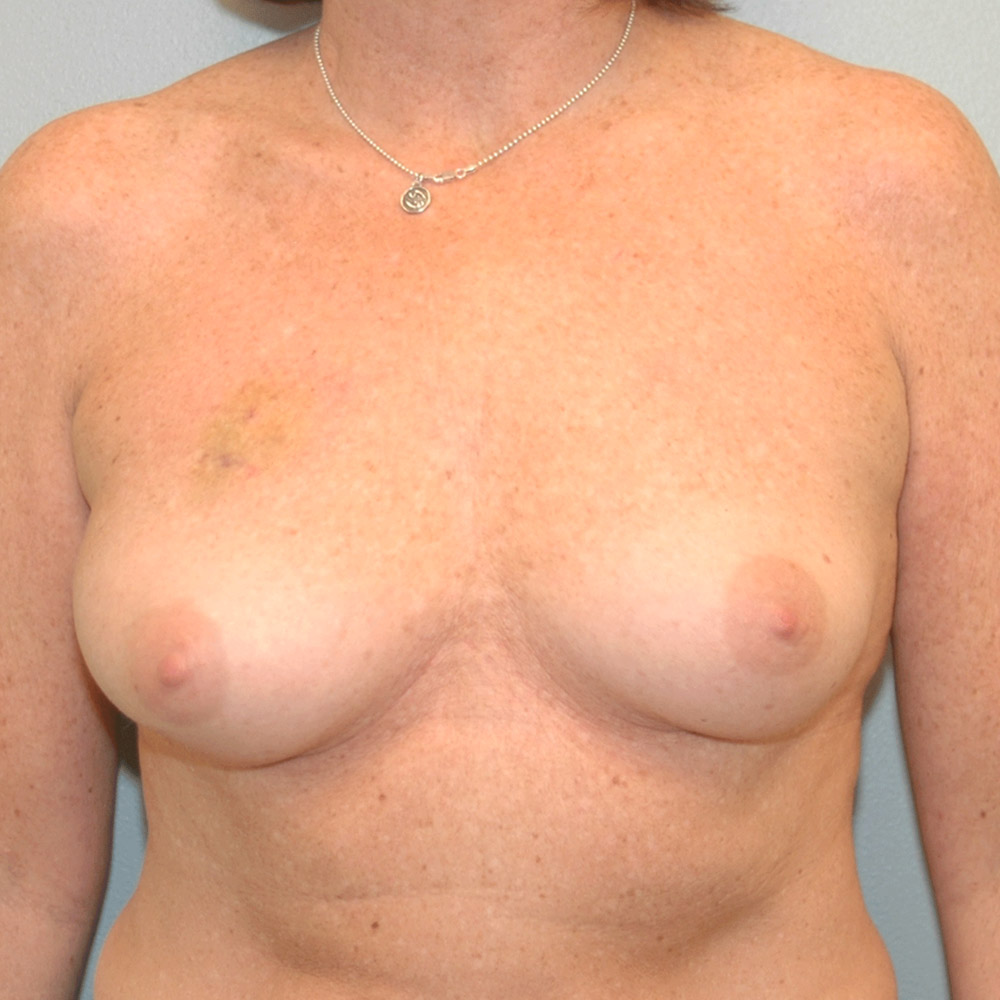 Case--2010 | Before Breast Reconstruction