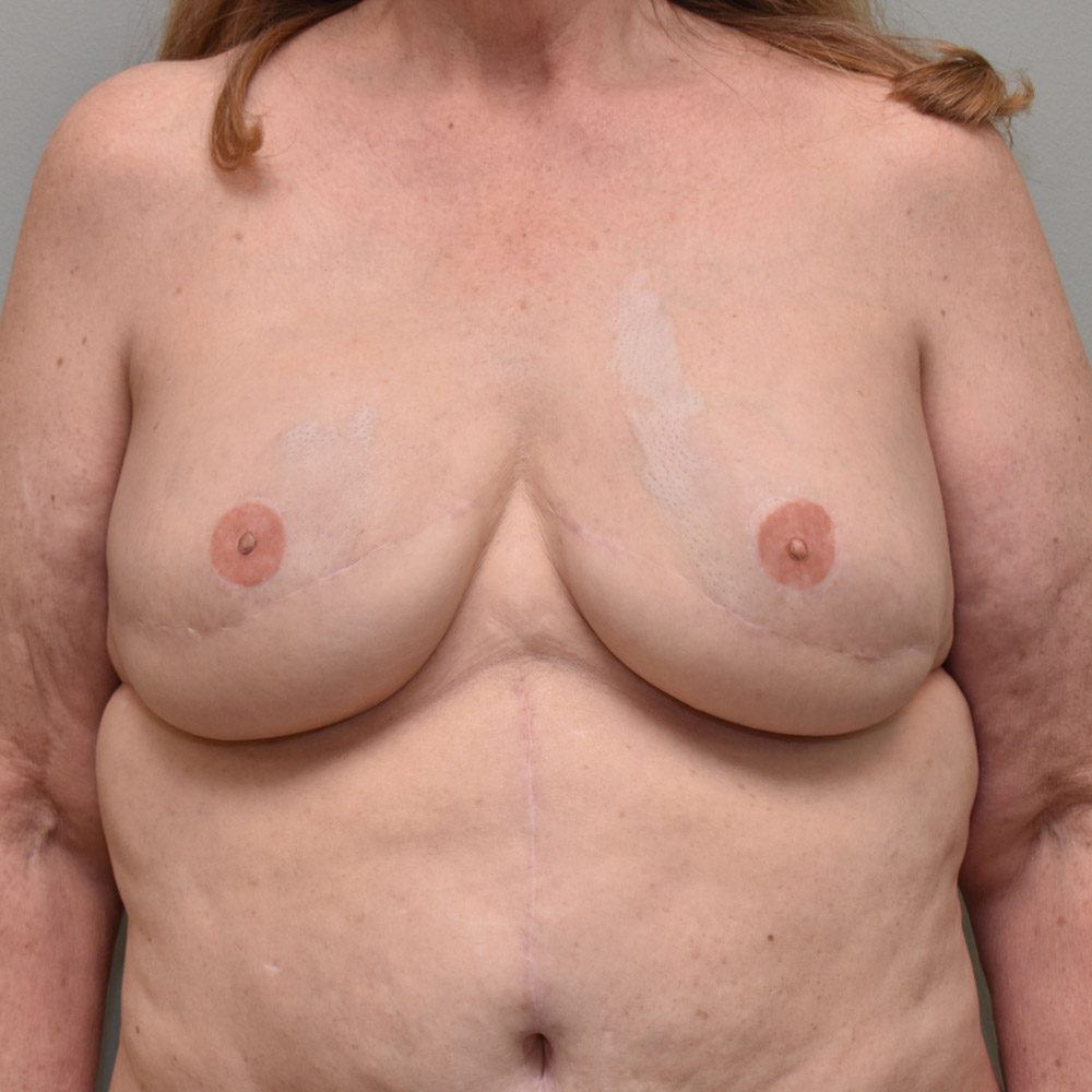 Case--2012 | After Breast Reconstruction