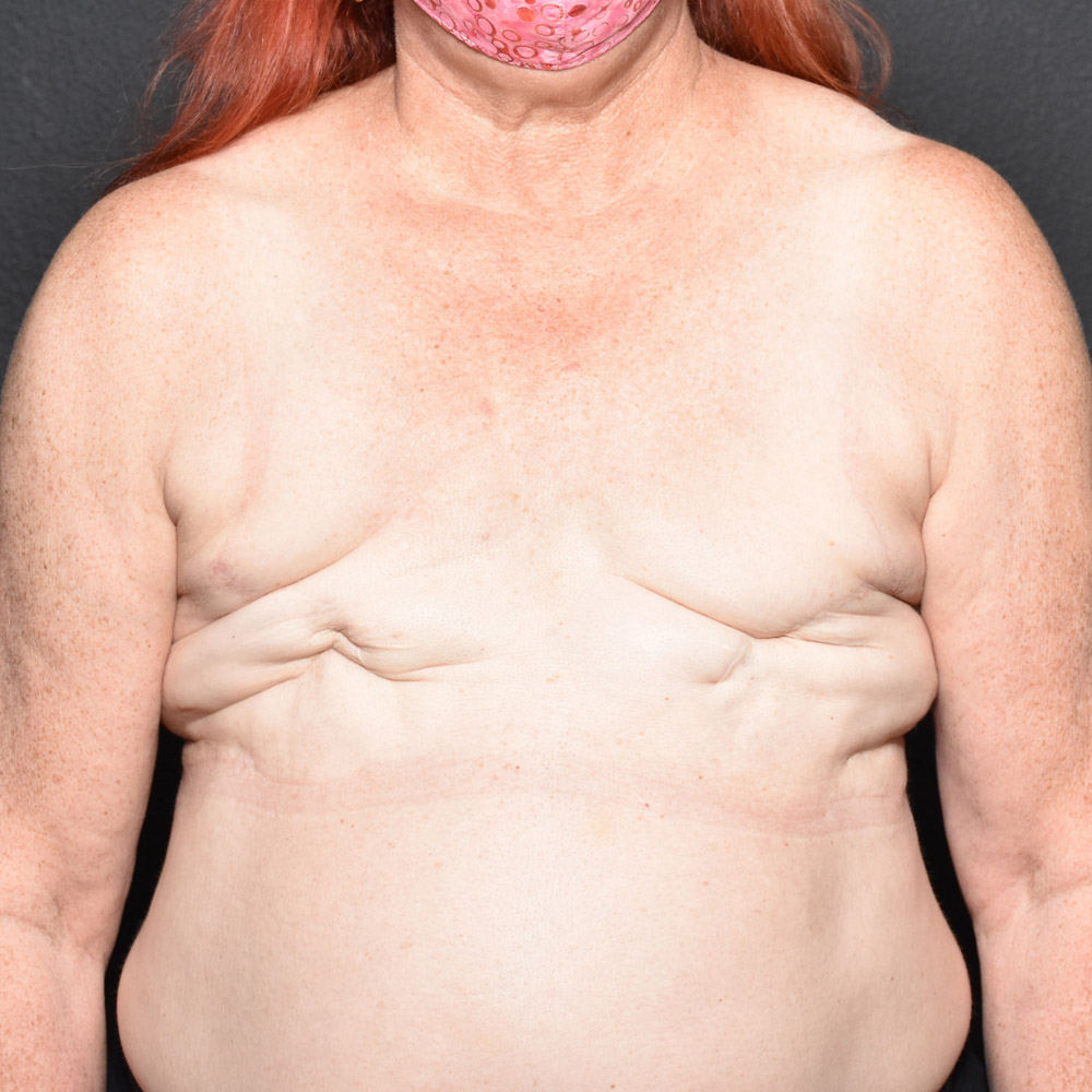 Case--2016 | Before Breast Reconstruction