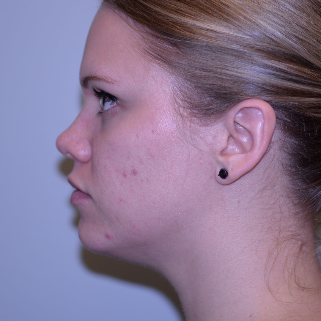 Case--3447 | Before Medical Grade Skincare