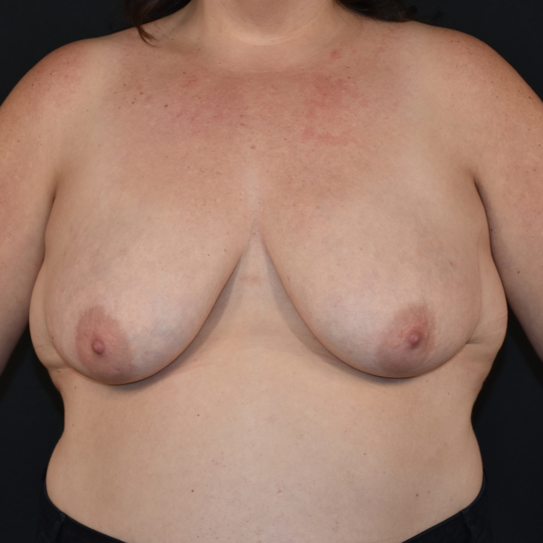 Case--1637 | Before Breast Reconstruction
