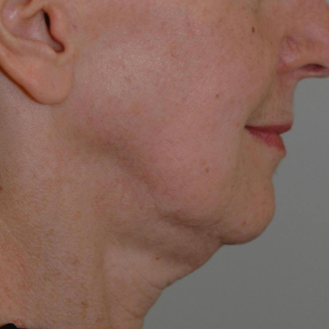 Case--4557 | Before Ultherapy