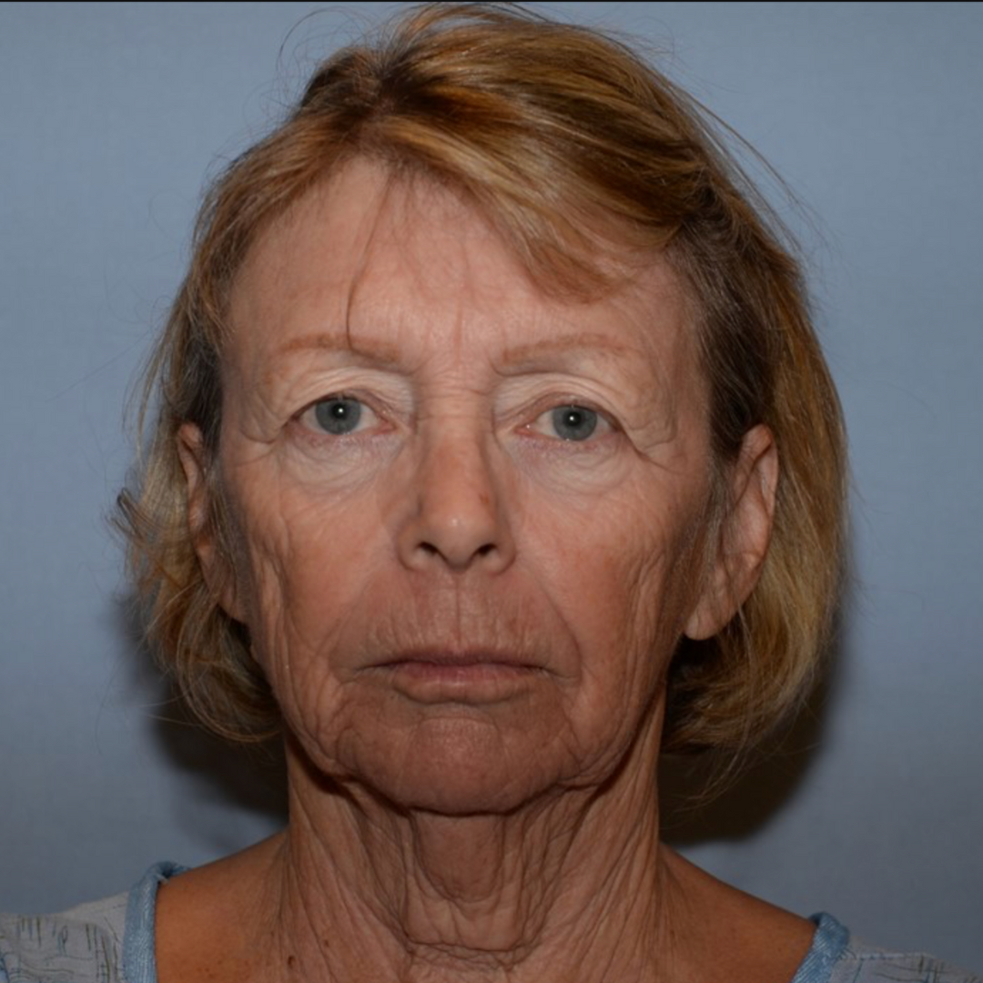 Case--2128 | Before Face Treatments