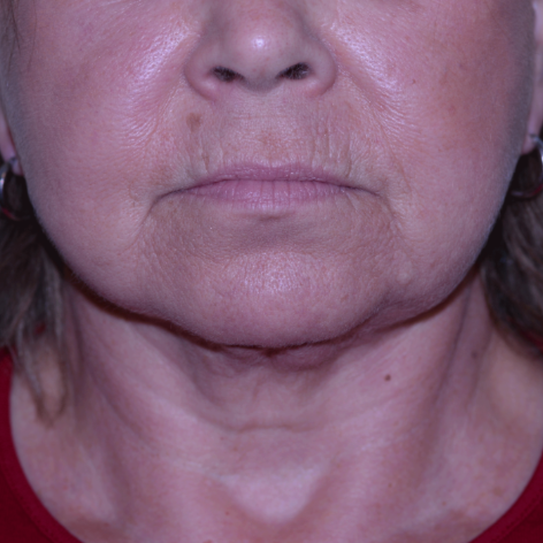 Case--9570 | After Facelift and Neck Lift