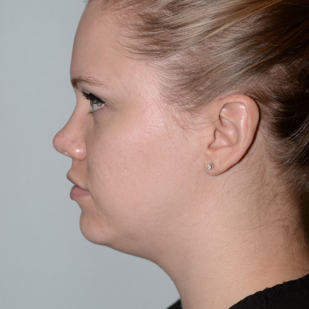 Case--3447 | After Medical Grade Skincare