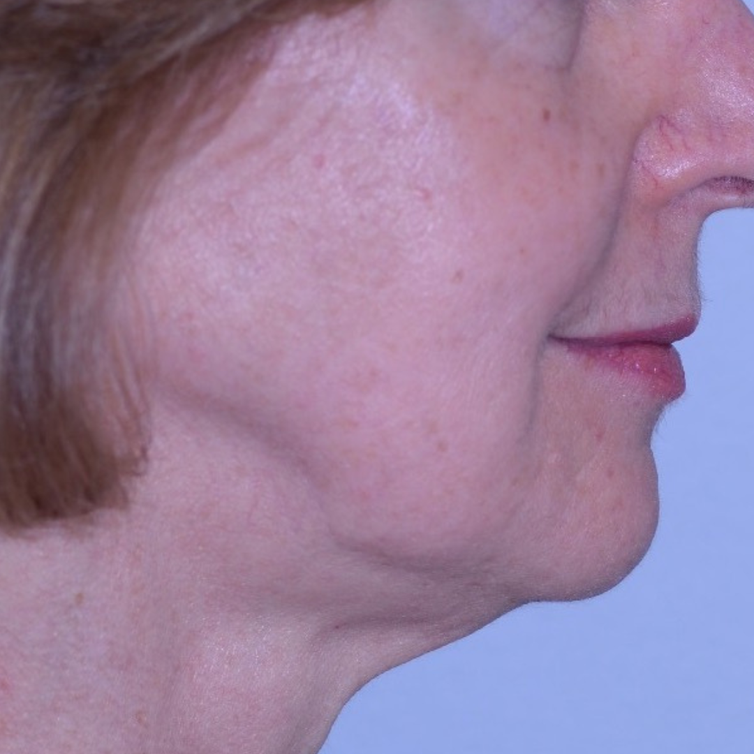 Case--4557 | After Ultherapy
