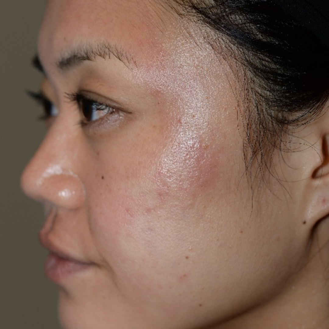 Case--6069 | Before IPL & Laser Treatments