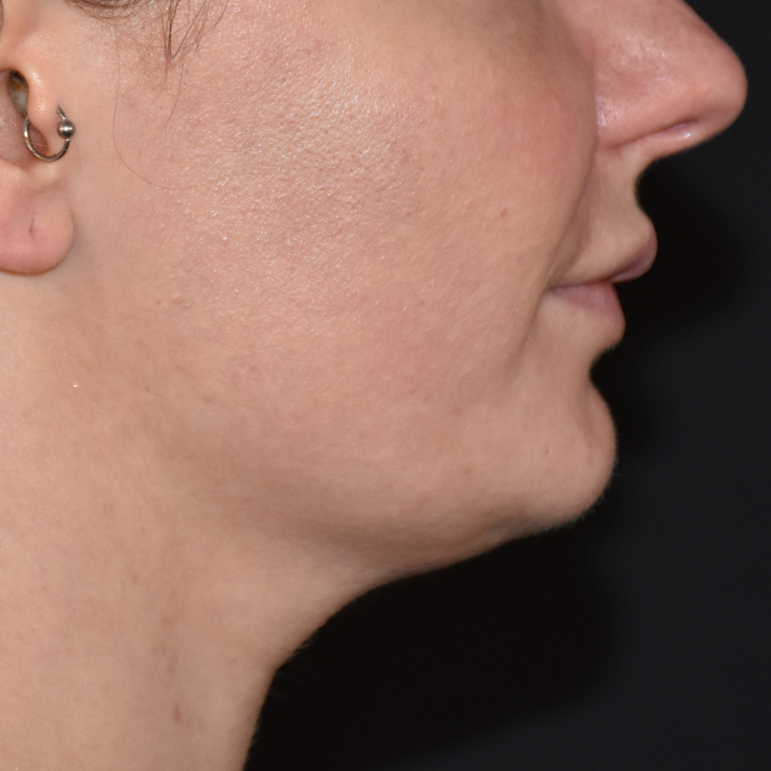 Case--2605 | Before Ultherapy