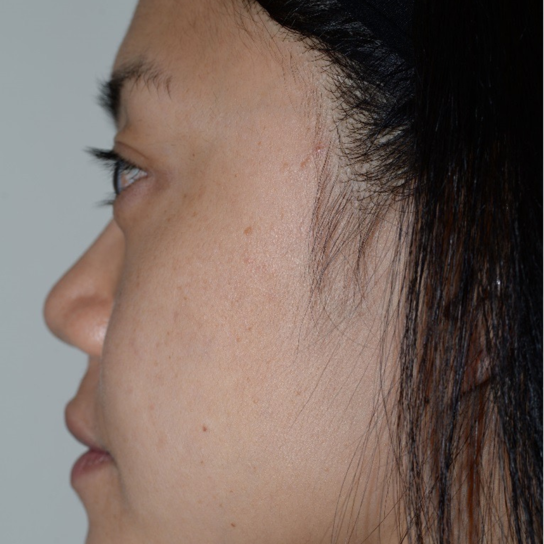 Case--6069 | After IPL & Laser Treatments