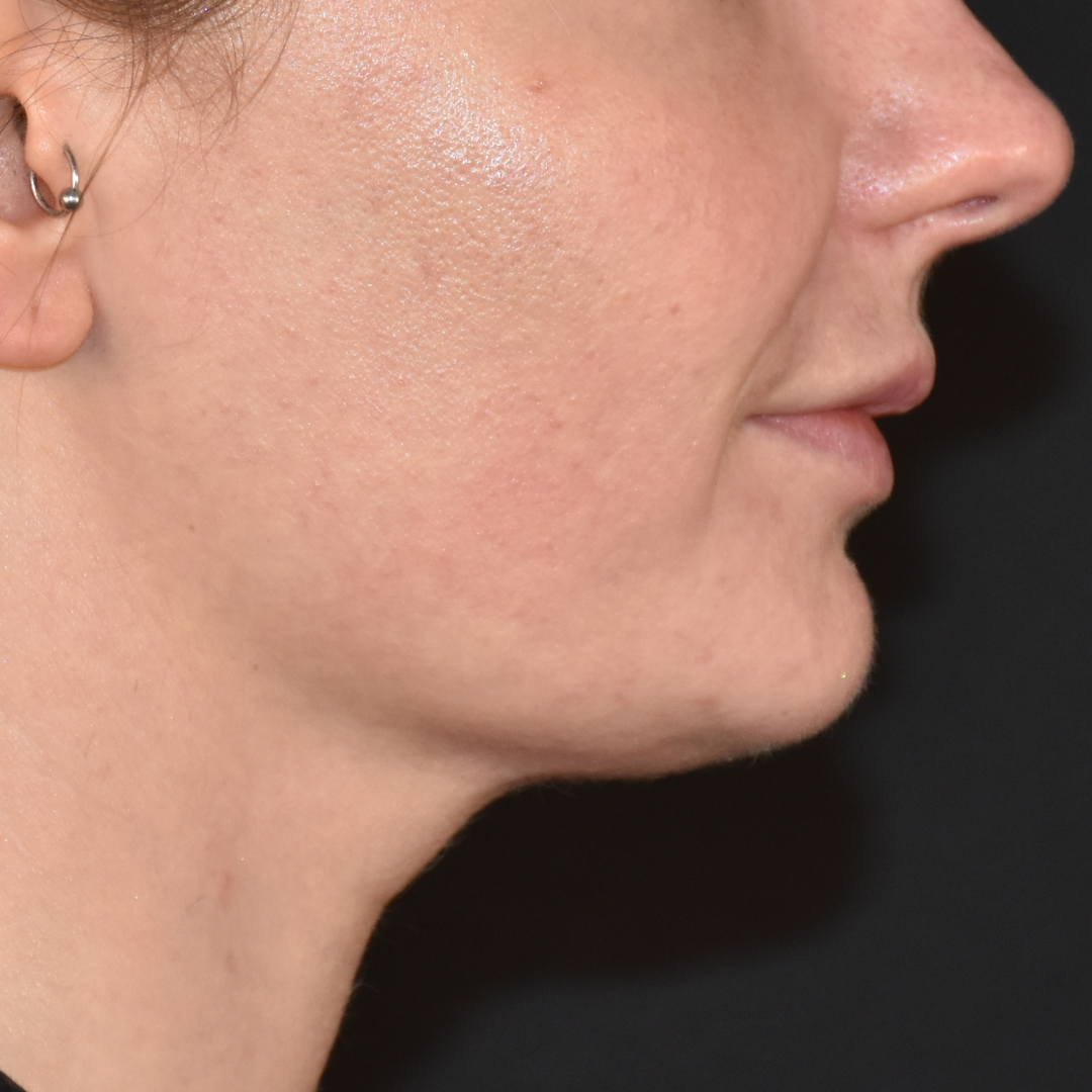 Case--2605 | After Ultherapy