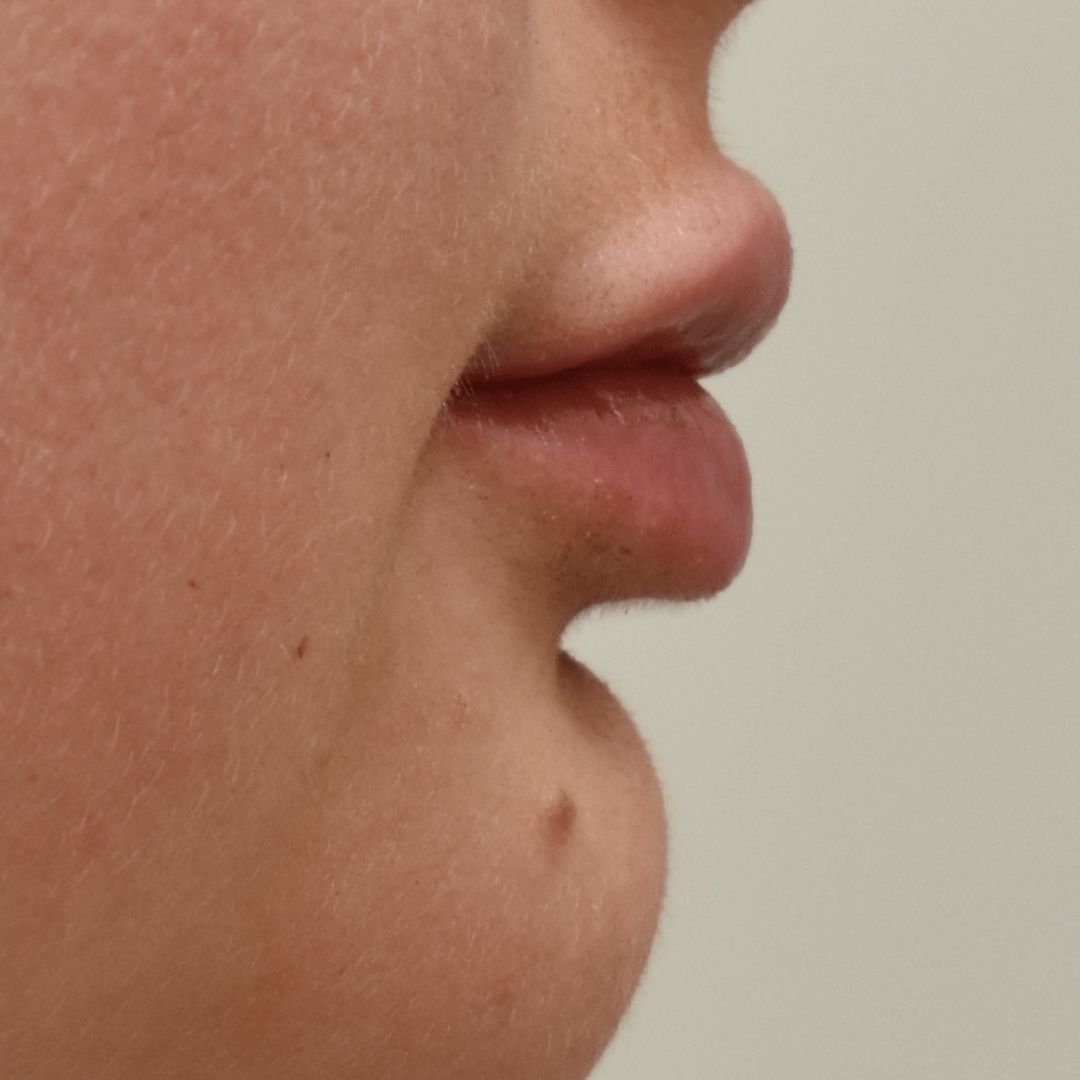 Case--8065 | After Facial Fillers 1