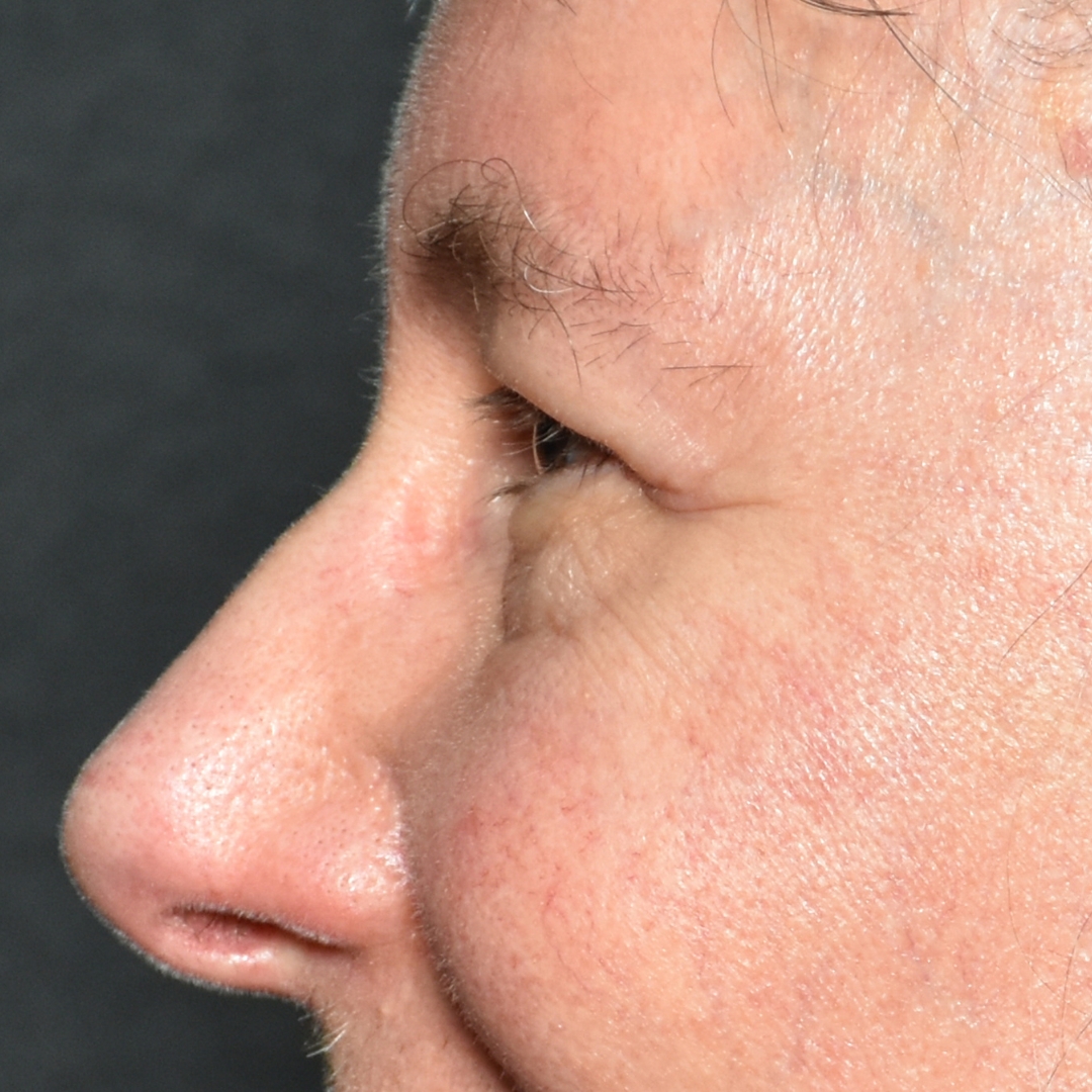 Case--5356 | After Upper Blepharoplasty 2