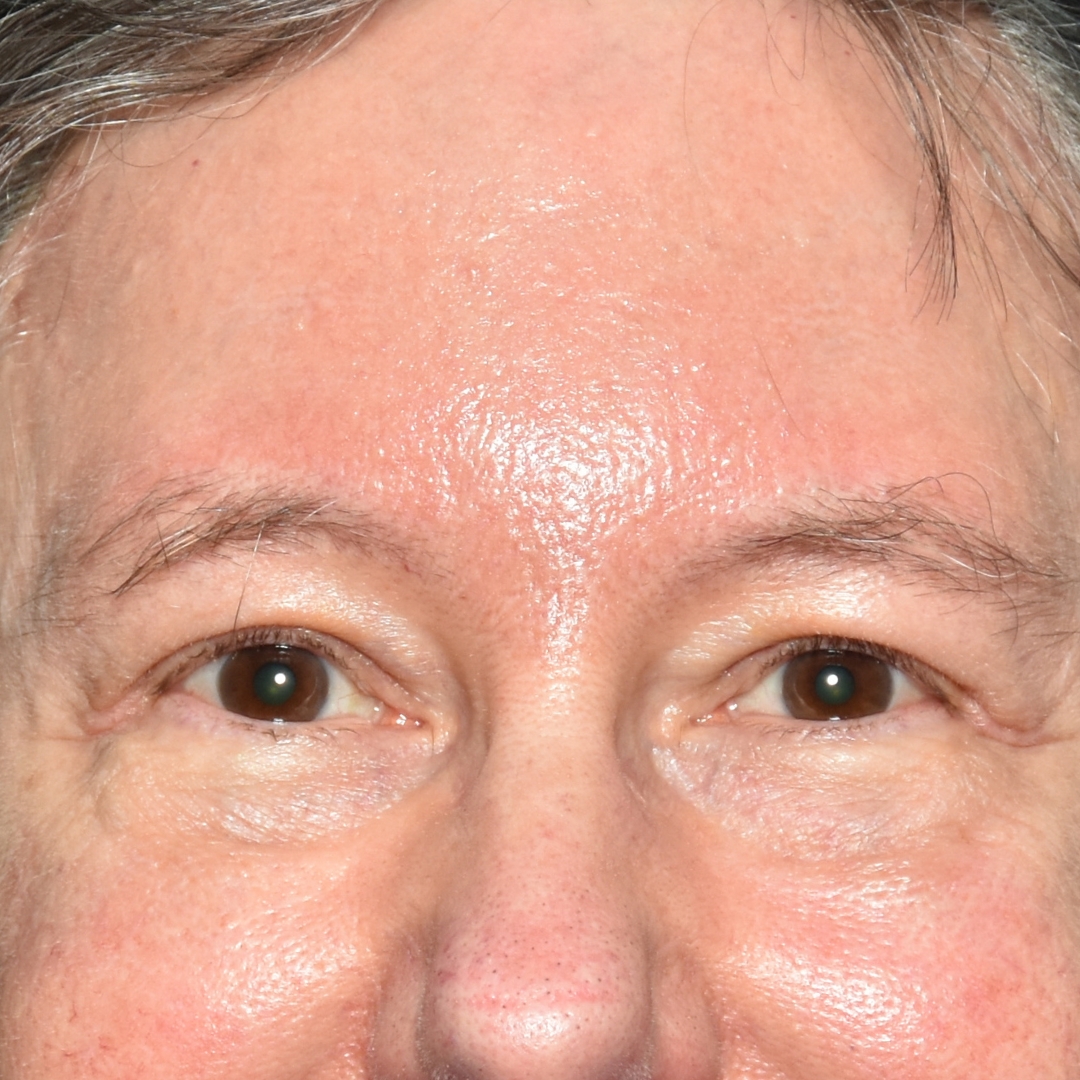 Case--5356 | After Upper Blepharoplasty