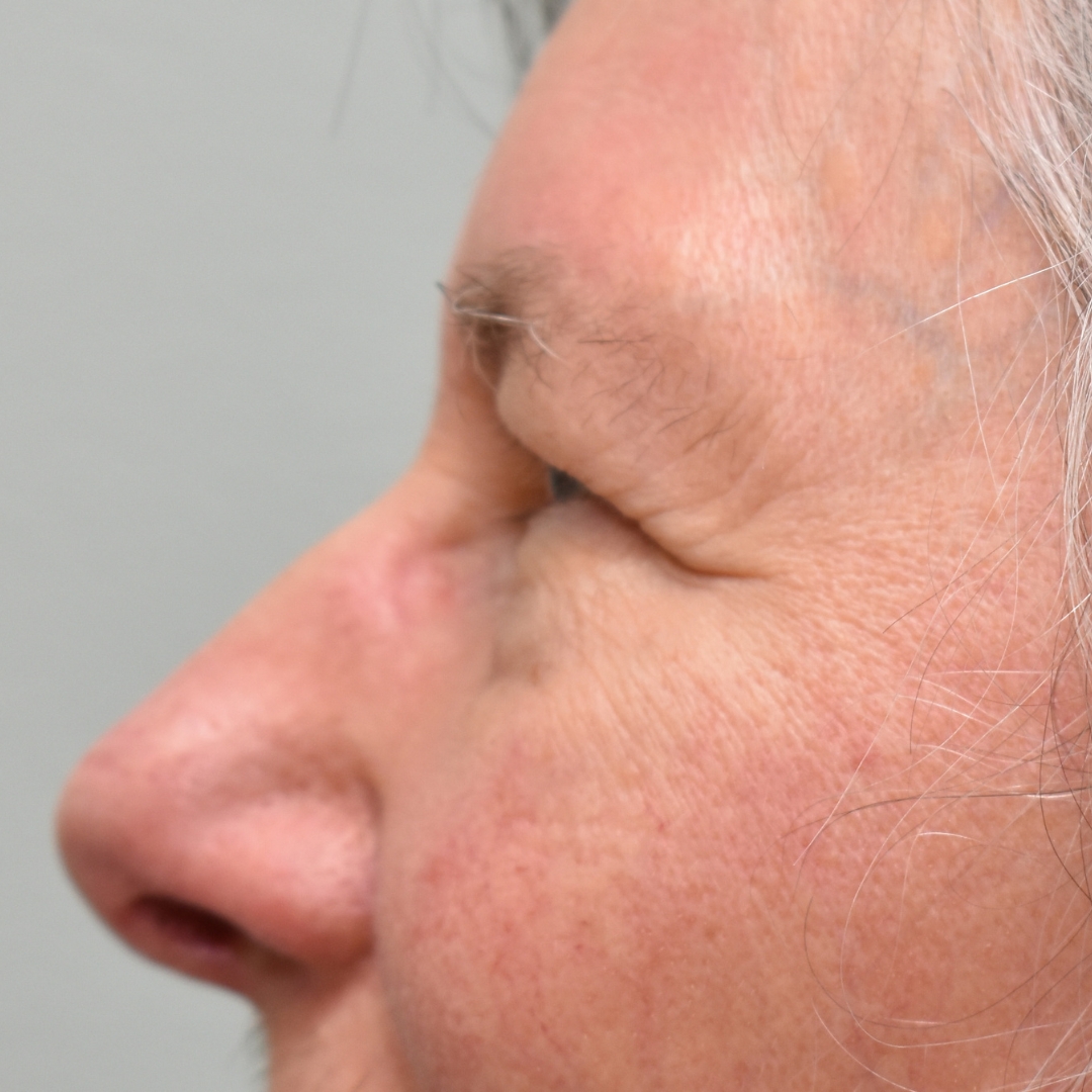 Case--5356 | Before Upper Blepharoplasty 2