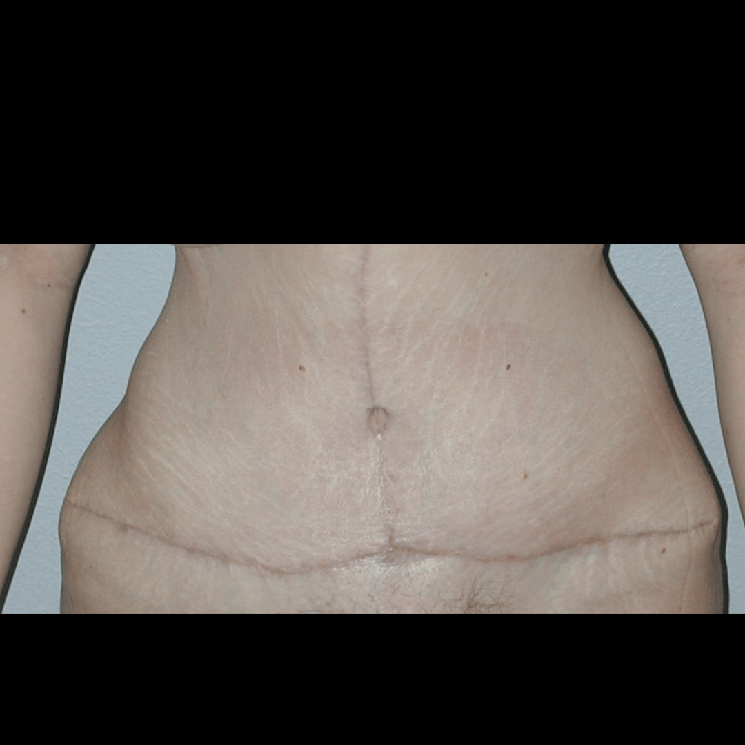 Case--60760 | After Massive Weight Loss