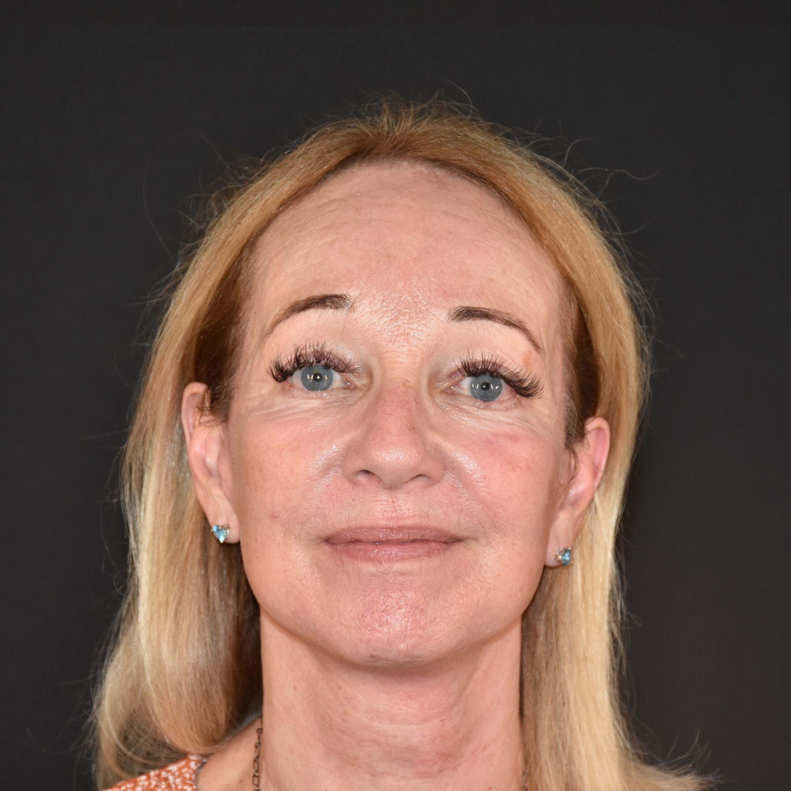 Case--3707 | After Upper Blepharoplasty