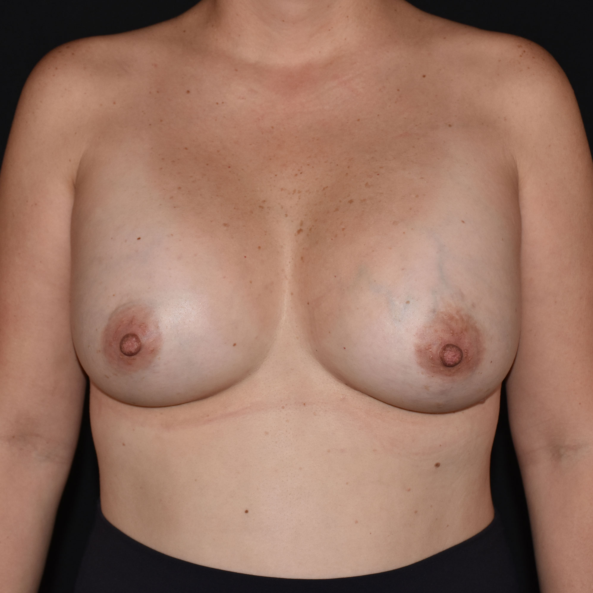 Case--1953 | After Breast Augmentation