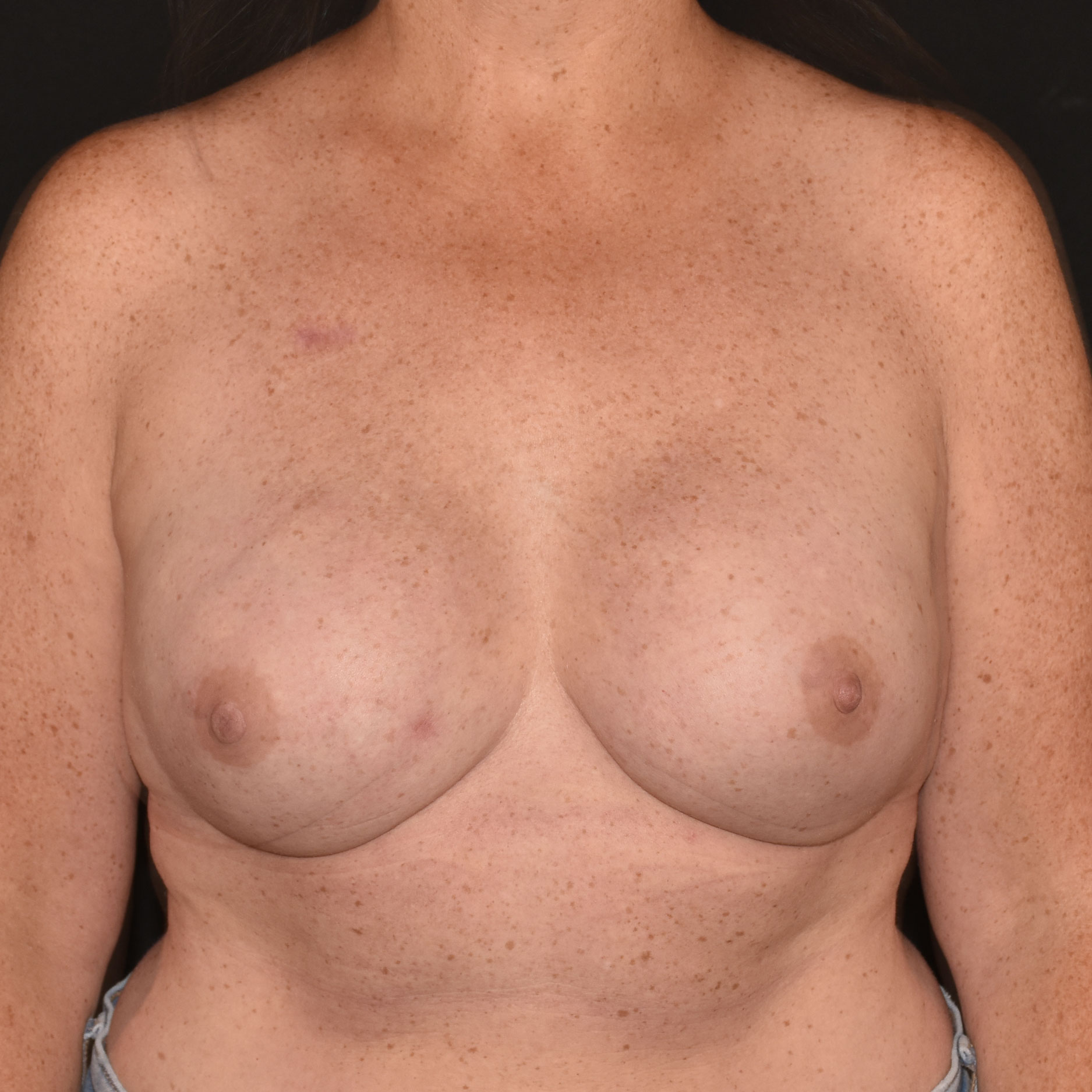 Case--9226 | After Breast Reconstruction