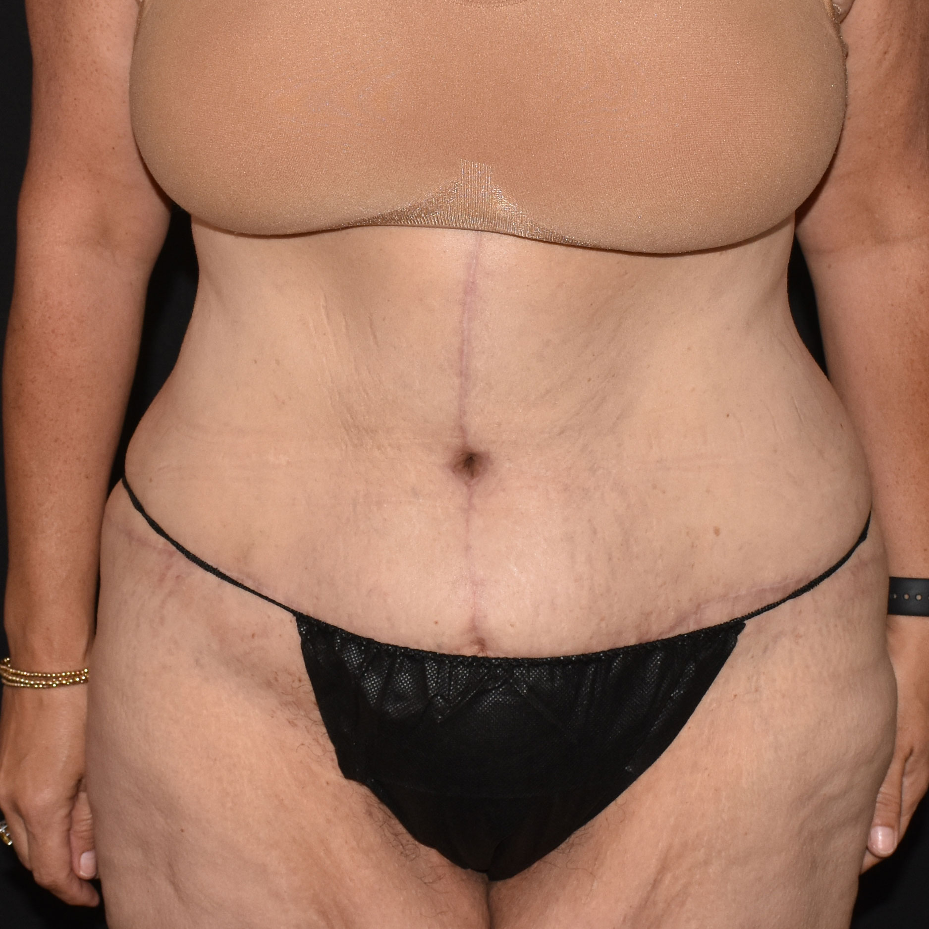 Case--2416 | After Tummy Tuck