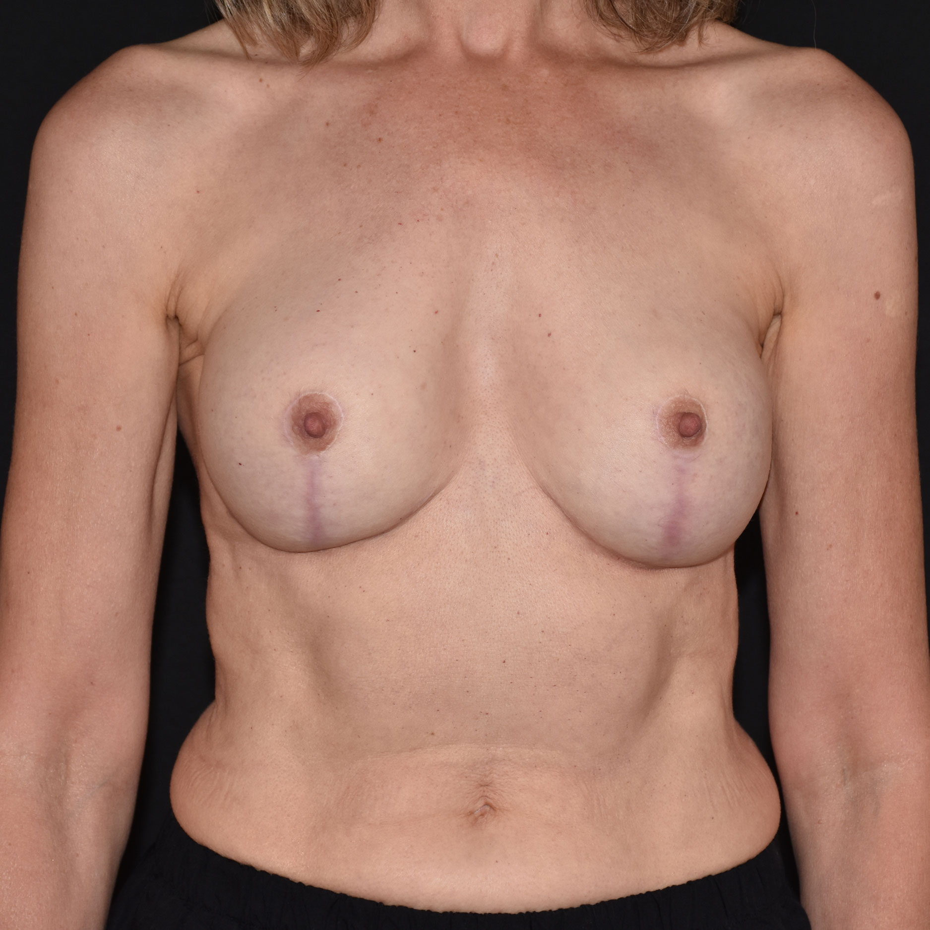 Case--9491 | After Breast Implant Removal or Revision