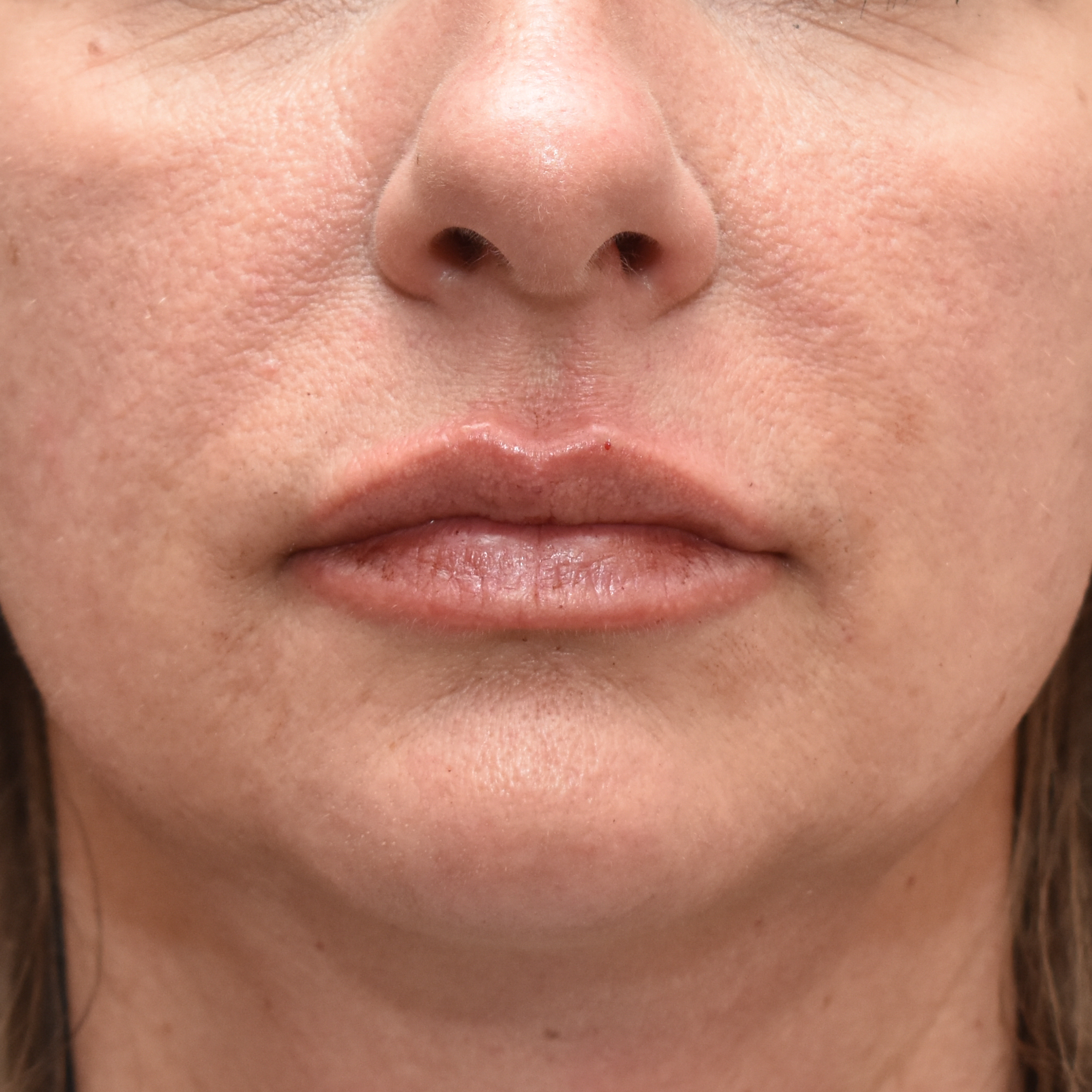 Case--4475 | After Facial Fillers 1