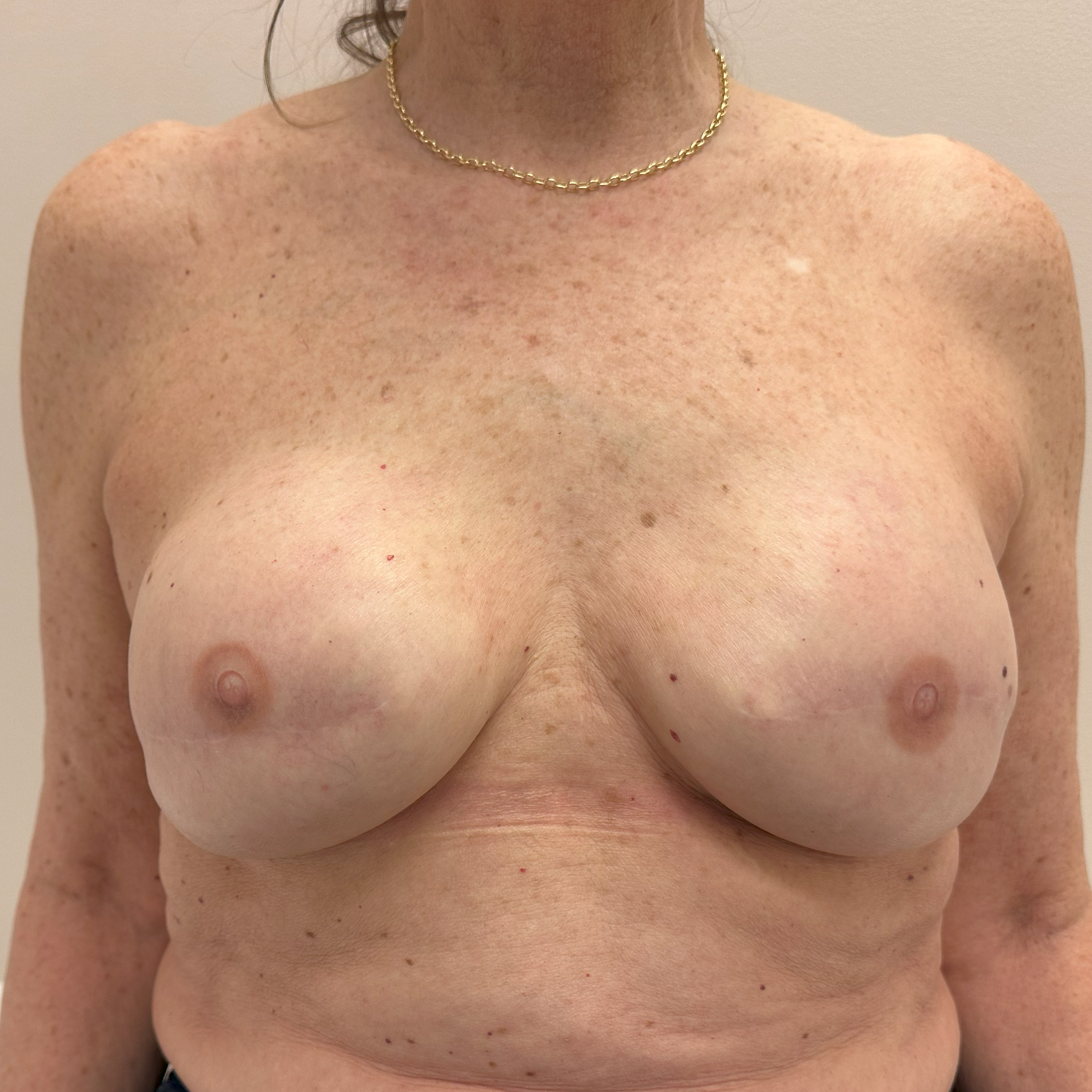 Case--8176 | After Breast Reconstruction