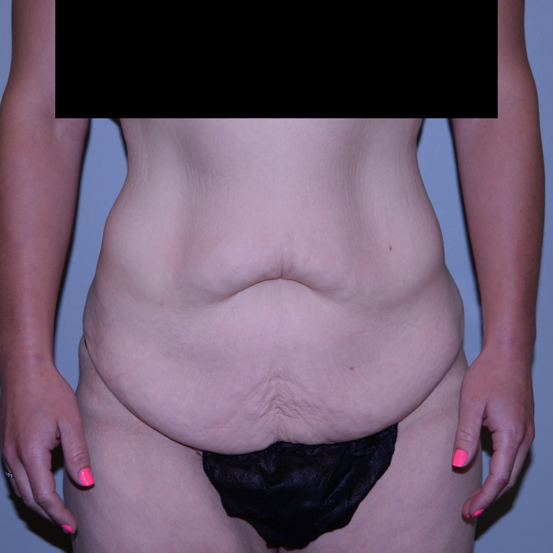 Case--5386 | Before Massive Weight Loss