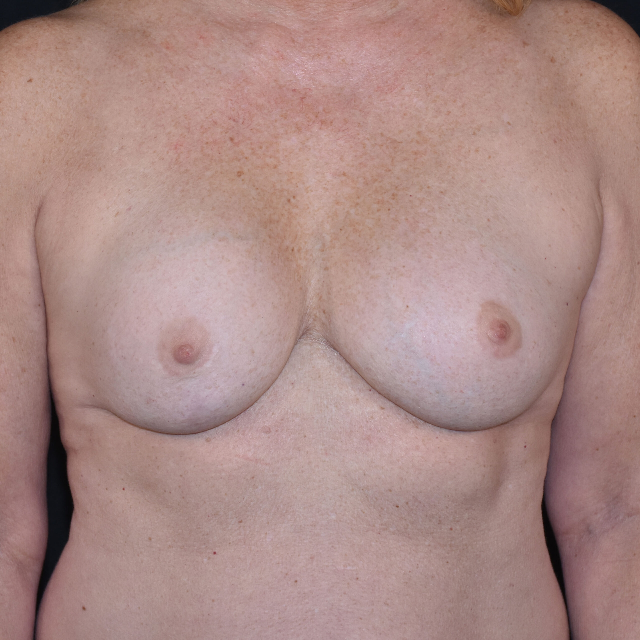 Case--5401 | Before Breast Implant Removal or Revision