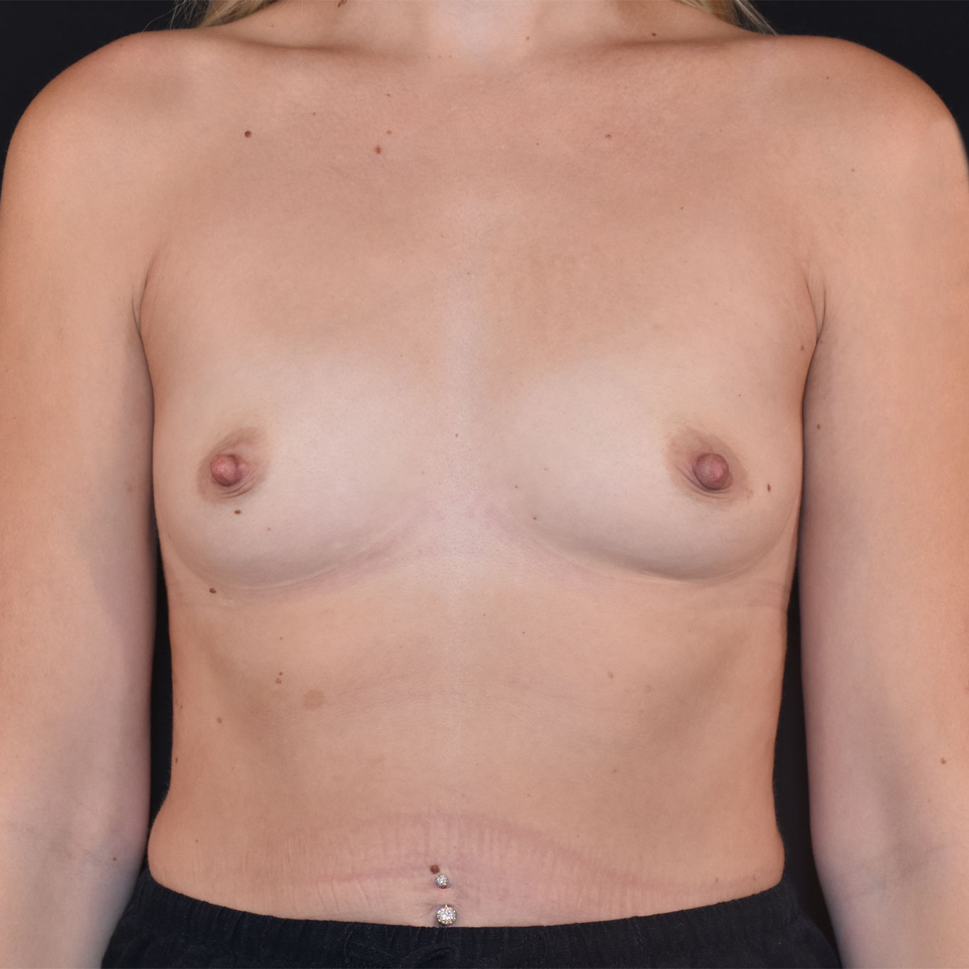 Pre Op Breast Augmentation