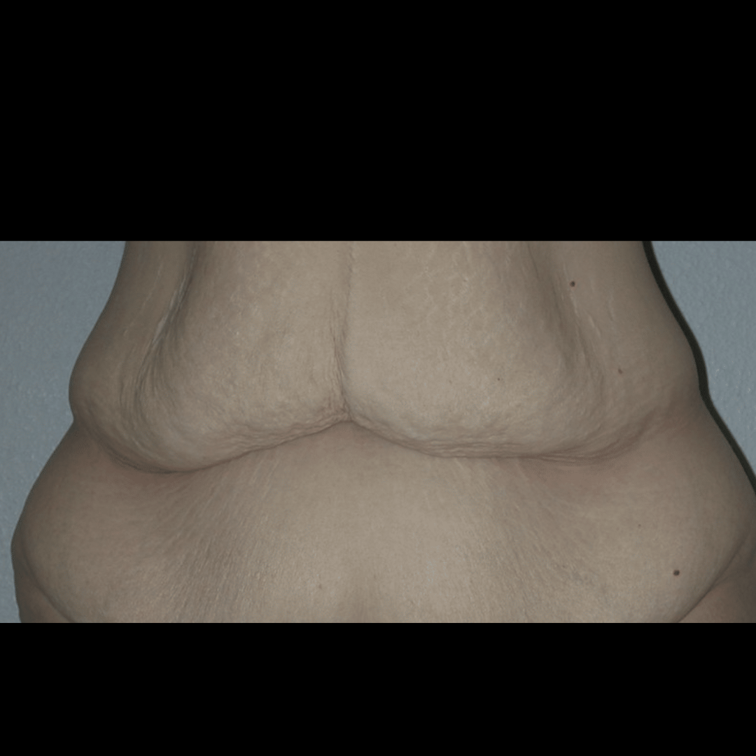 Case--60760 | Before Massive Weight Loss