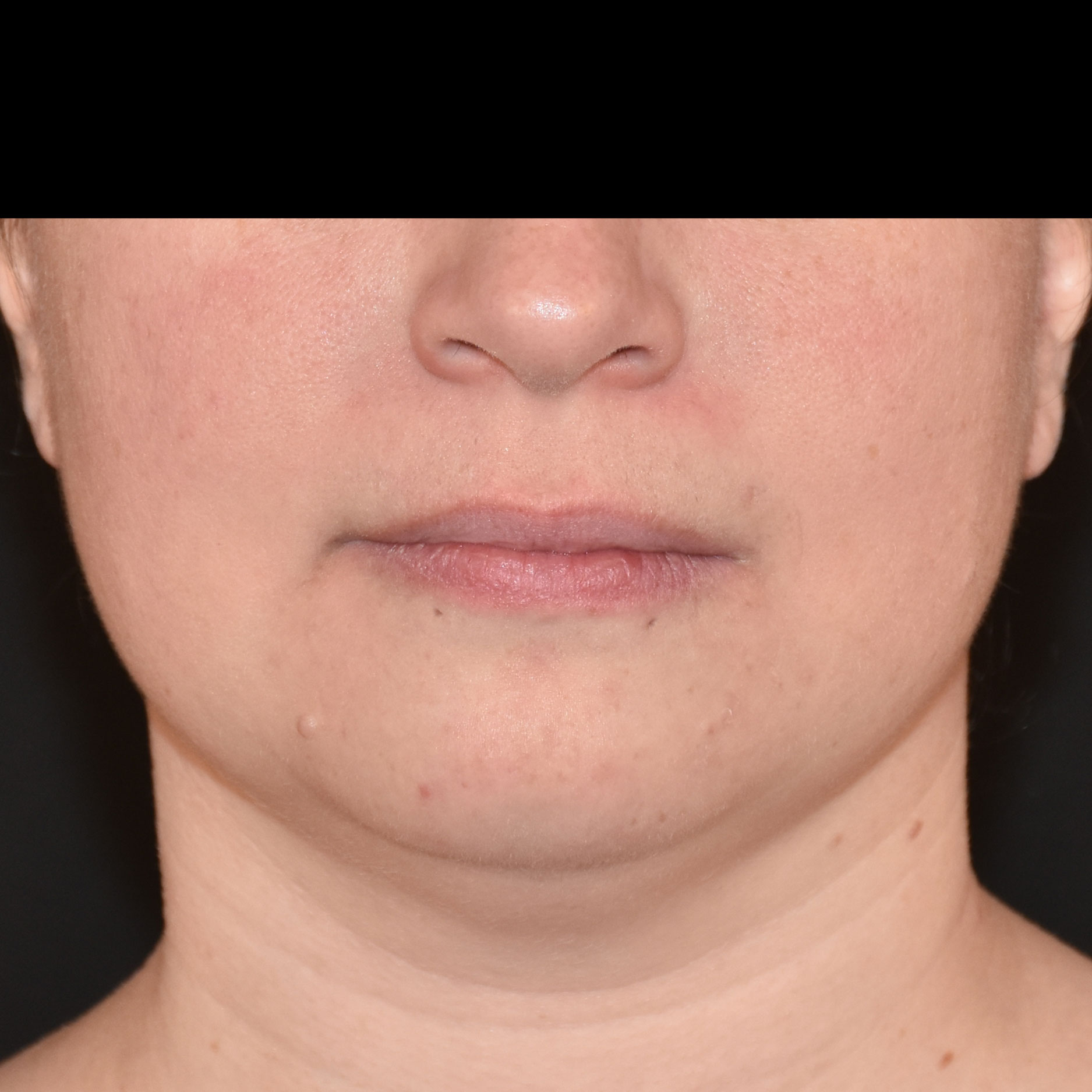 Case--8379 | Before Skin Tightening