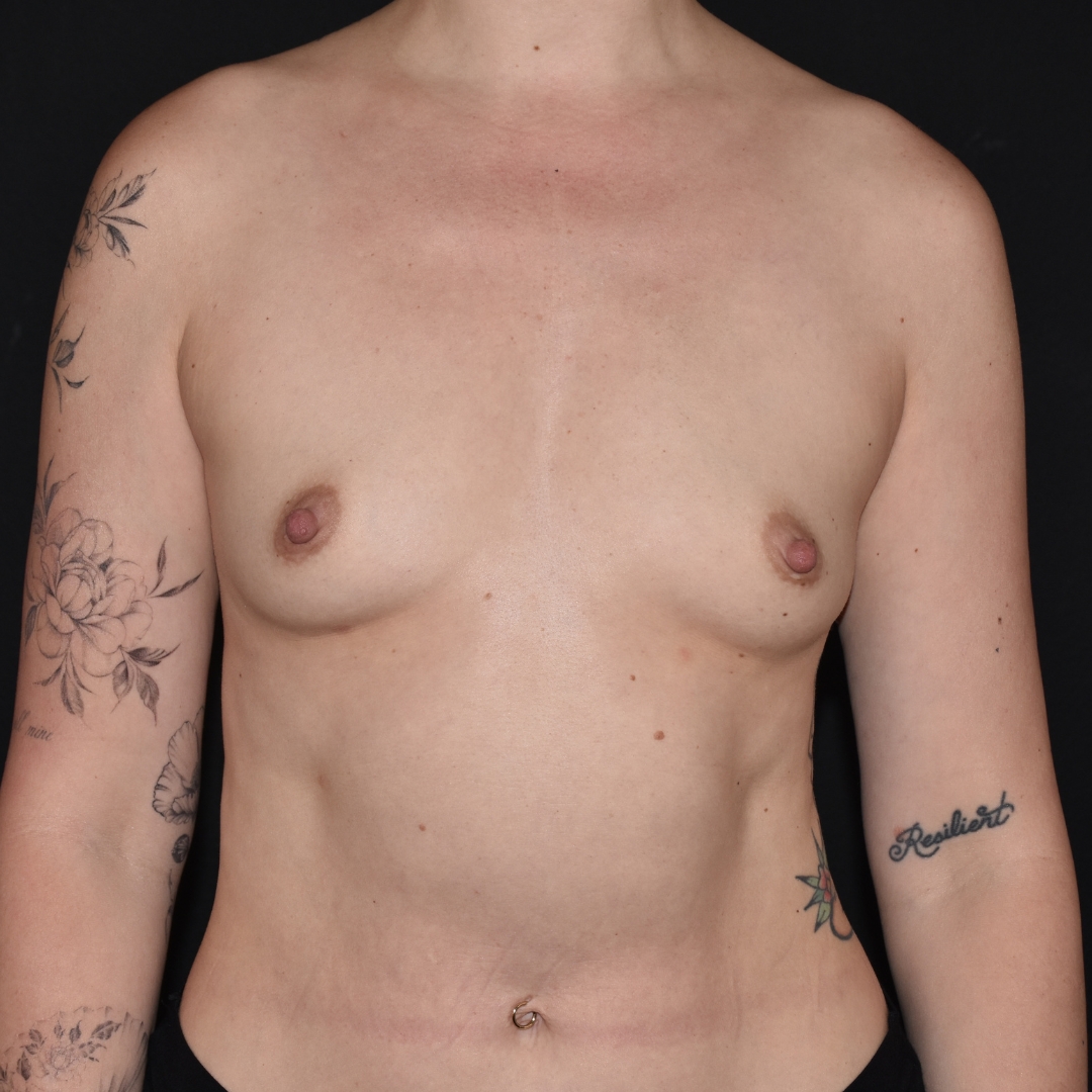 Case--5001 | Before Breast Augmentation Preservé