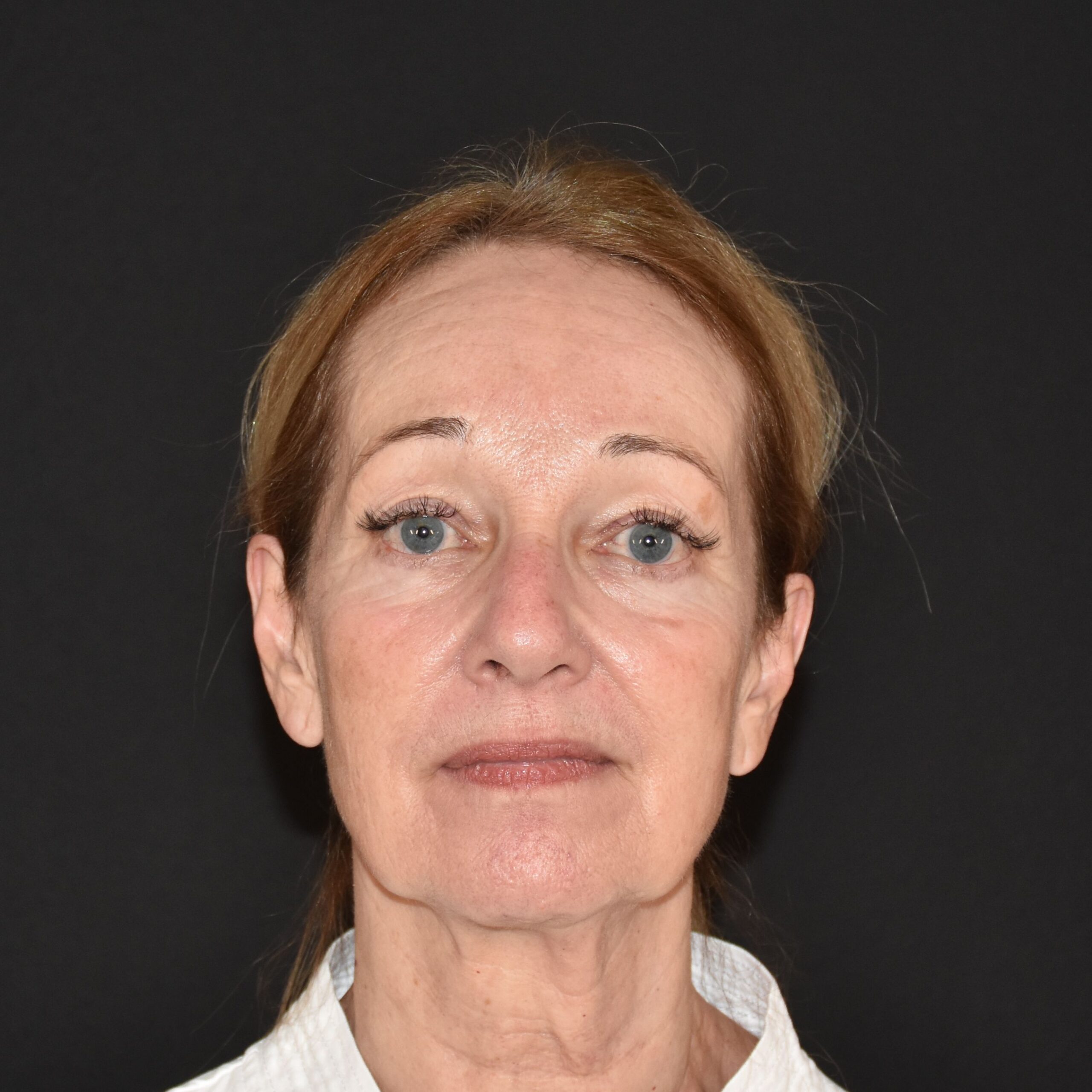 Case--3488 | Before Facelift and Neck Lift