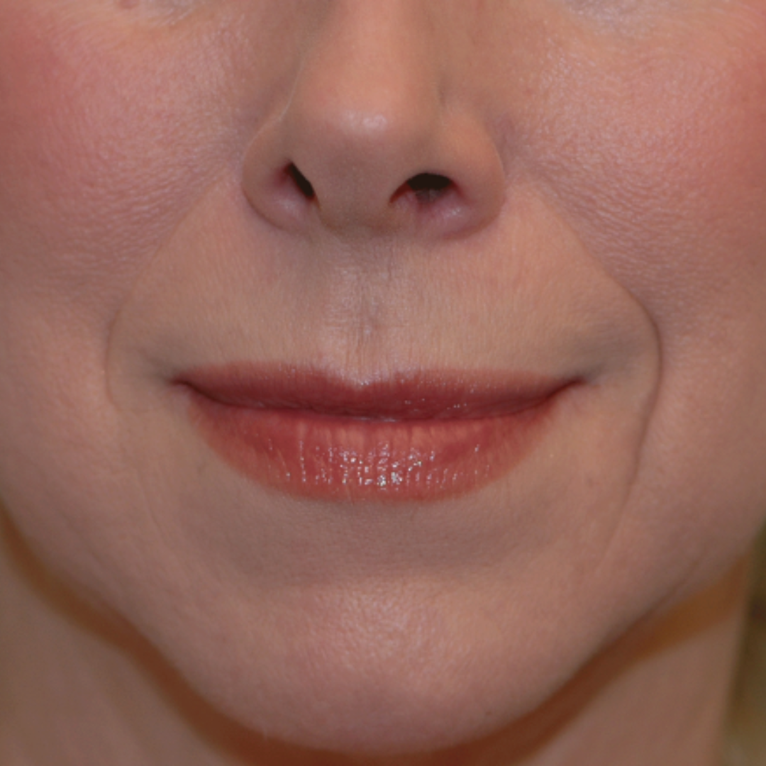Case--6007 | Before Facial Fillers 1
